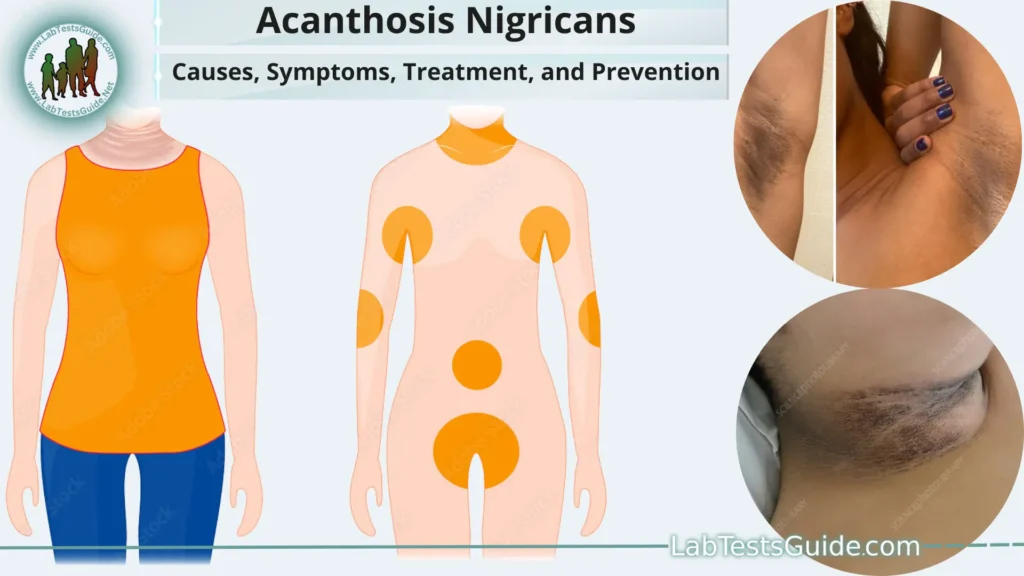 acanthosis nigricans neck