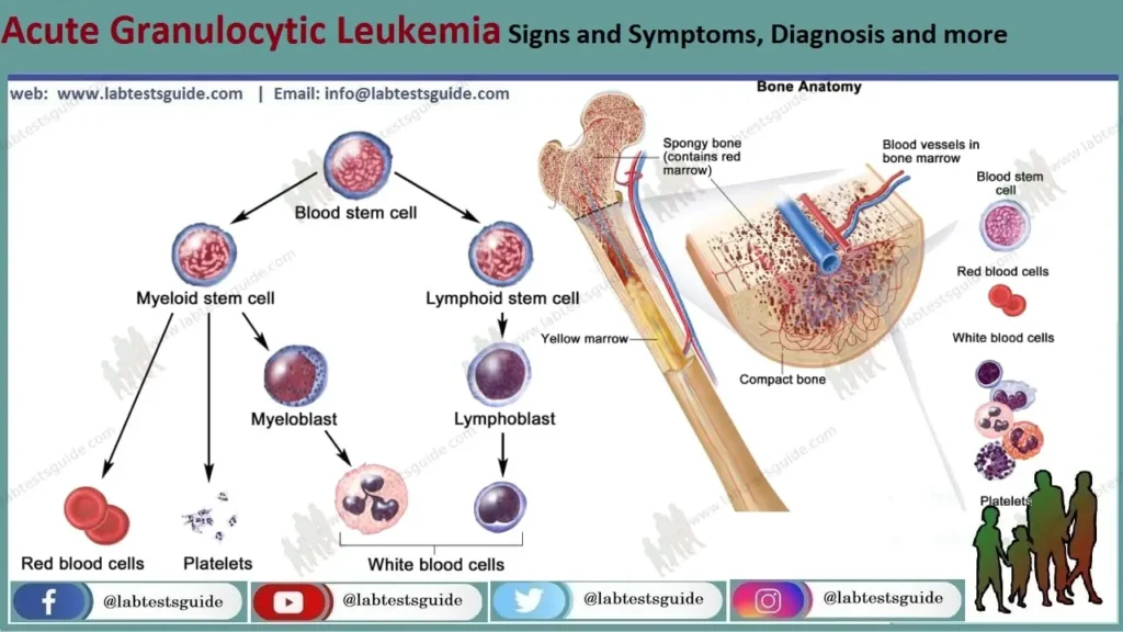 Acute Granulocytic Leukemia AGL Lab Tests Guide