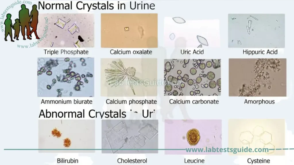 Crystals in Urine