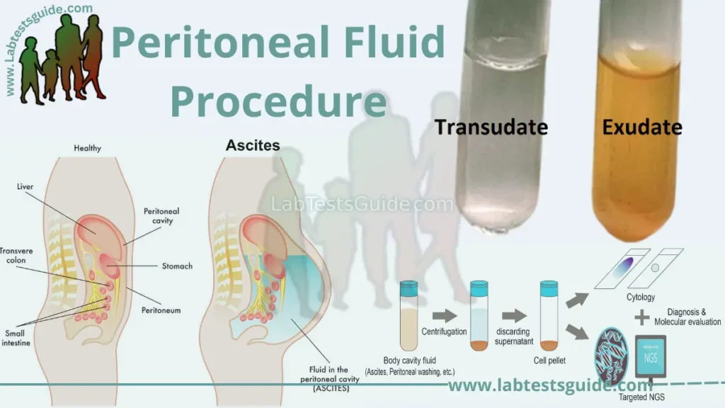 Peritoneal Fluid Procedure