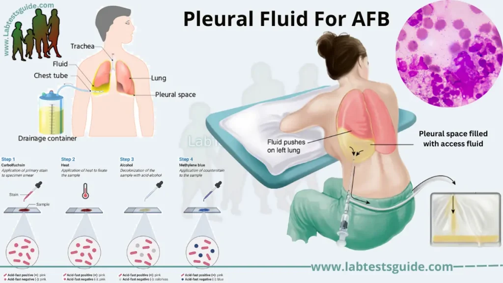 Pleural Fluid For AFB
