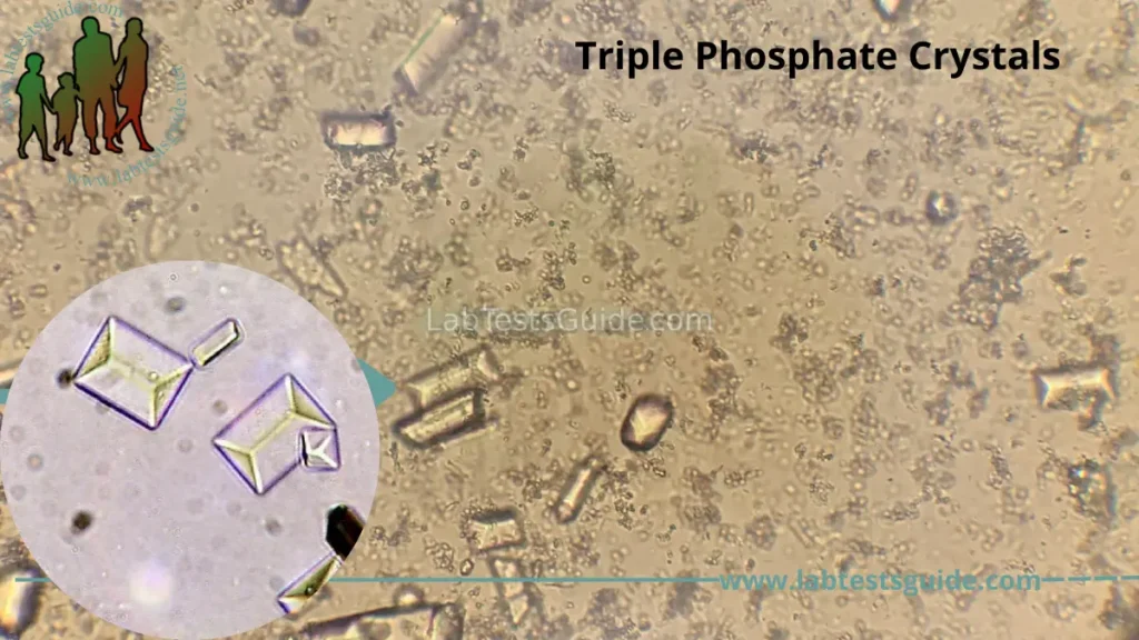 Triple Phosphate Crystals