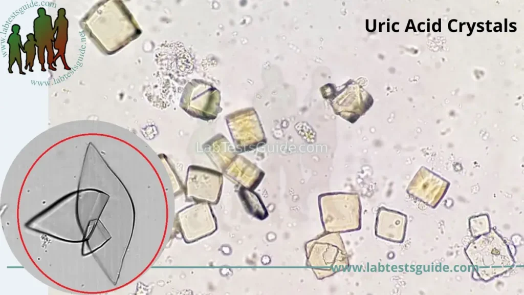 Uric acid Crystals