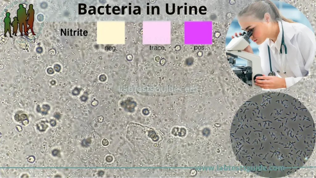 Bacteria in Urine