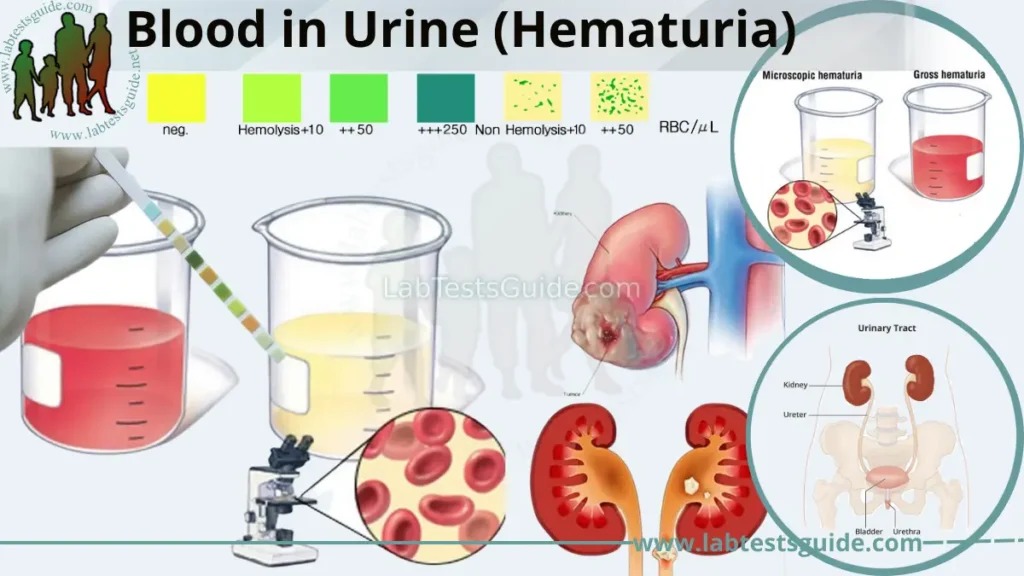 Blood in Urine (Hematuria)