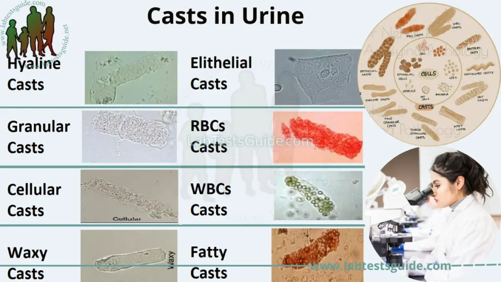 Casts in Urine