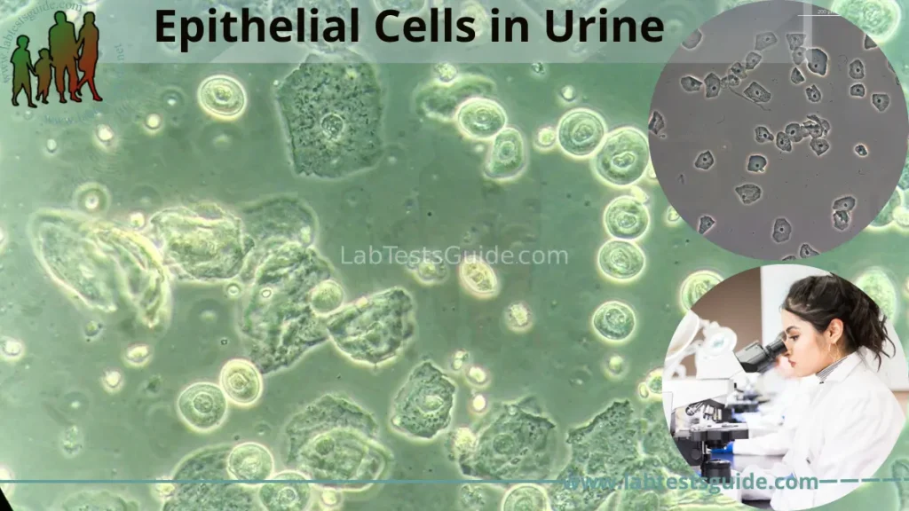Epithelial Cells in Urine