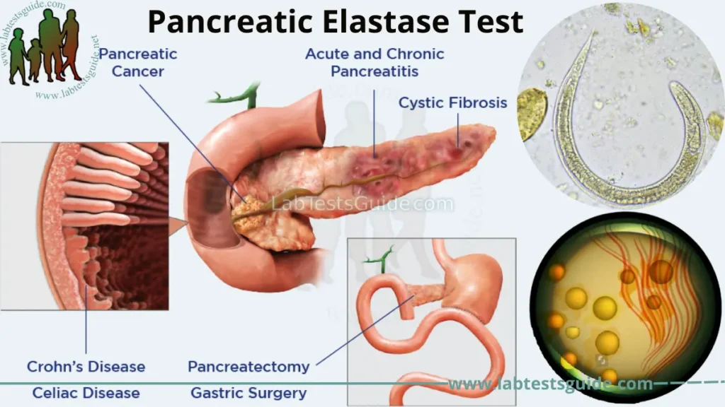 Pancreatic Elastase Test