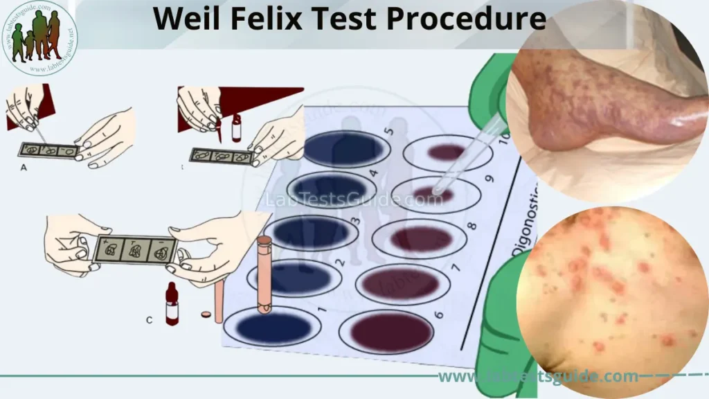 Weil Felix Test Procedure