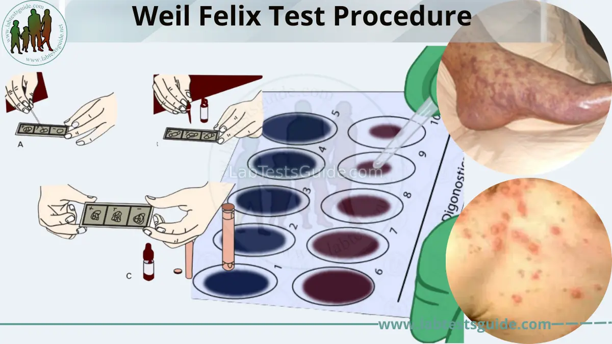 Weil Felix Test Procedure Principle Results And Clinical Significance