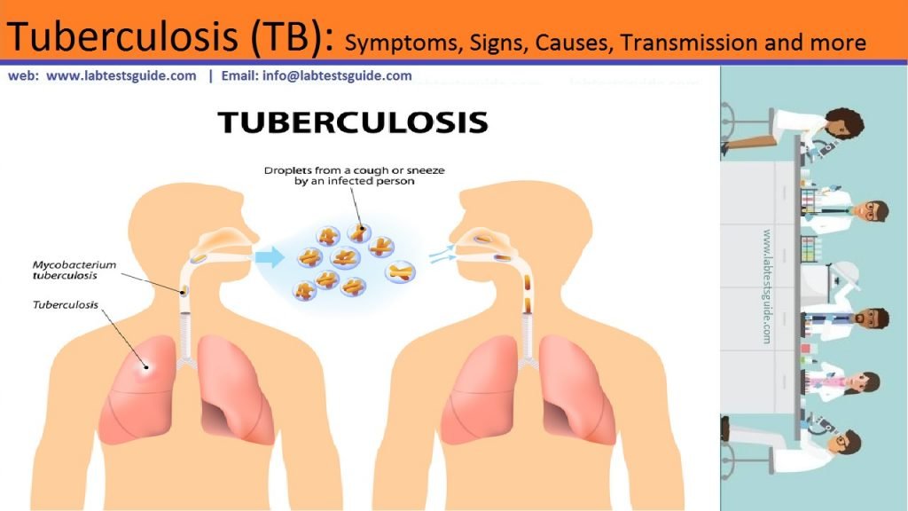 How Long Does Tb Last Without Treatment