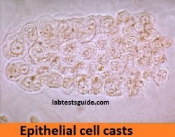 Urinery Casts Types, Results And Clinical Significations | Lab Tests Guide