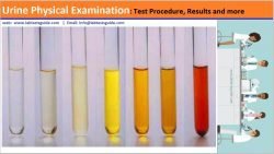 Urine Odor Test Purpose, Causes, Overview and more | Lab Tests Guide