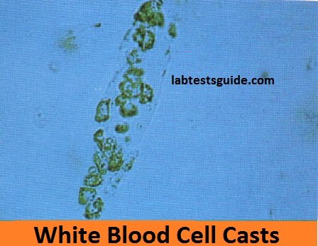 fatty casts in urine