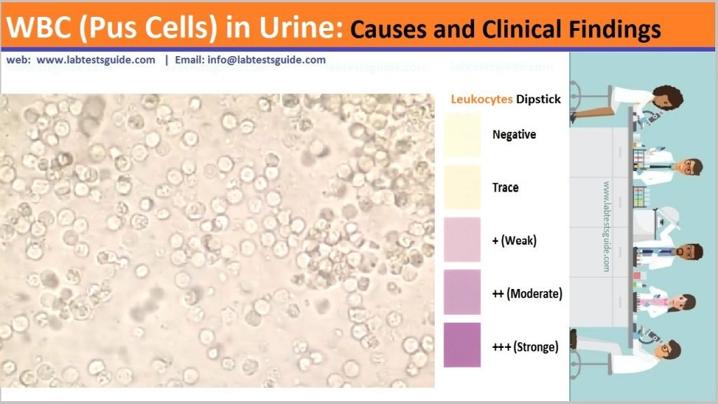 Wbc Pus Cells In Urine Causes And Clinical Findings Lab Tests Guide 8663