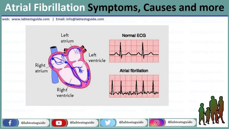 Atrial Fibrillation Symptoms, Causes, Prevention and more - Lab Tests Guide