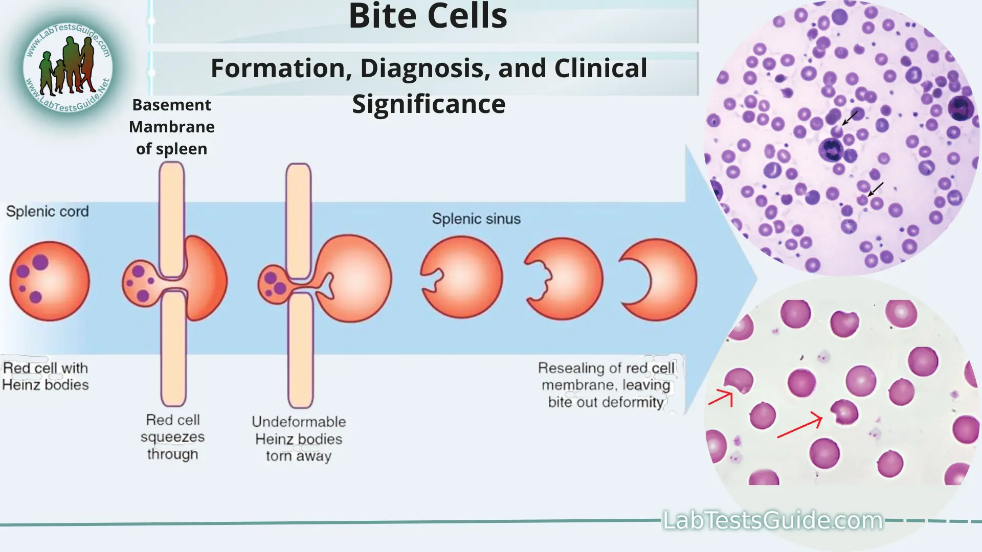 Bite Cells Formation Diagnosis And Clinical Significance