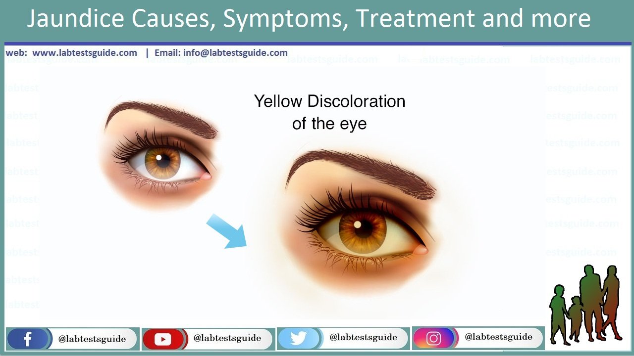 Jaundice Causes Symptoms Treatment And More Lab Tests Guide   Jaundice 