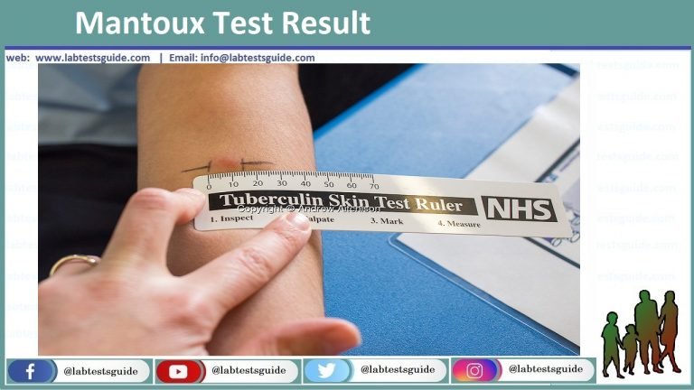 tuberculosis-skin-test-ppd-porpuse-procedure-results-lab-tests-guide