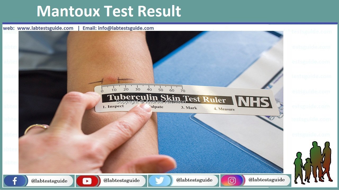 tuberculosis-skin-test-ppd-porpuse-procedure-results-lab-tests-guide