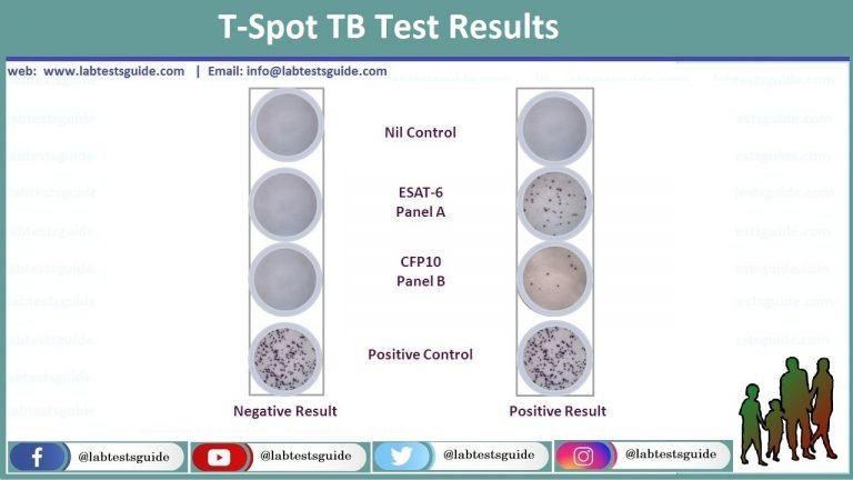 t-spot-test-procedure-results-and-interpretation-lab-tests-guide