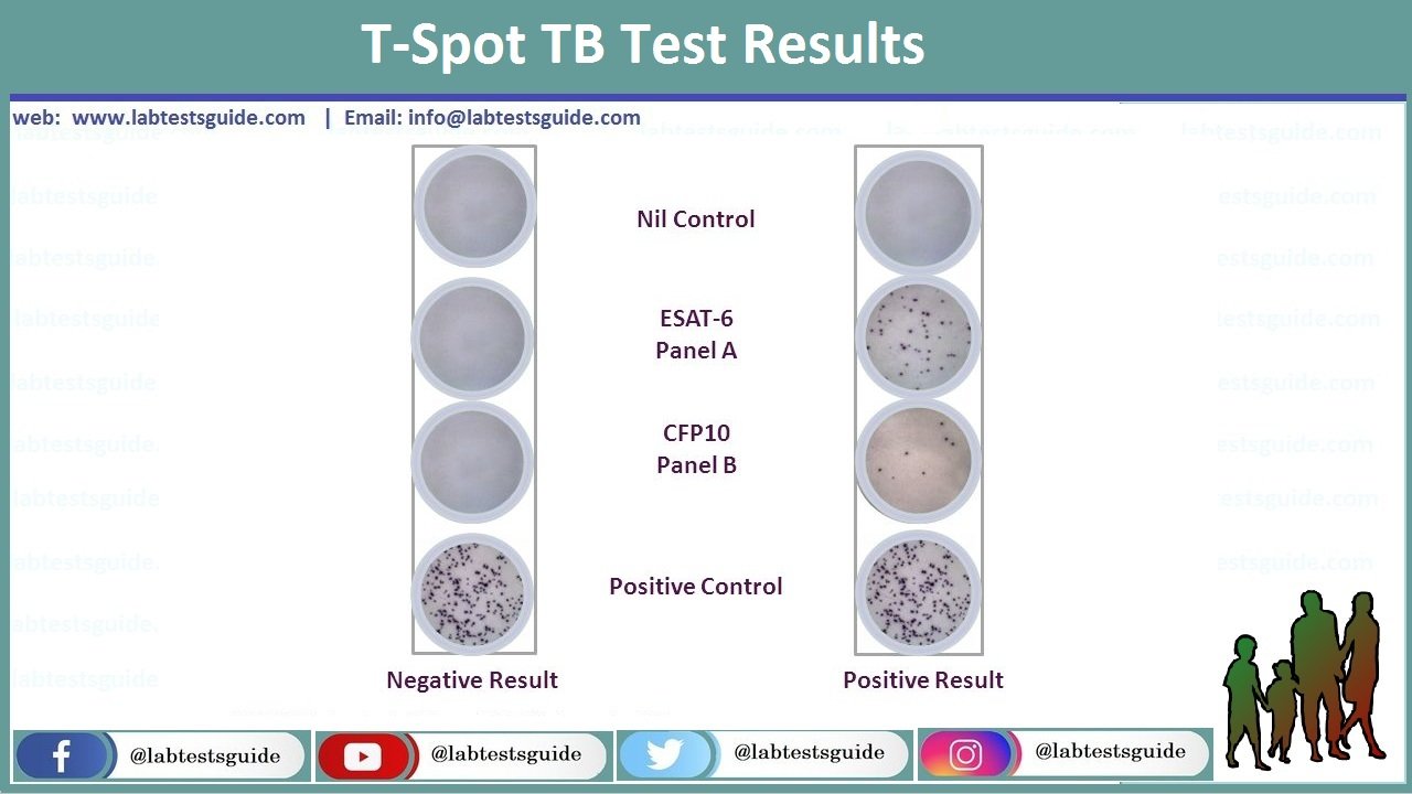 T-Spot Test Procedure, Results And Interpretation | Lab Tests Guide