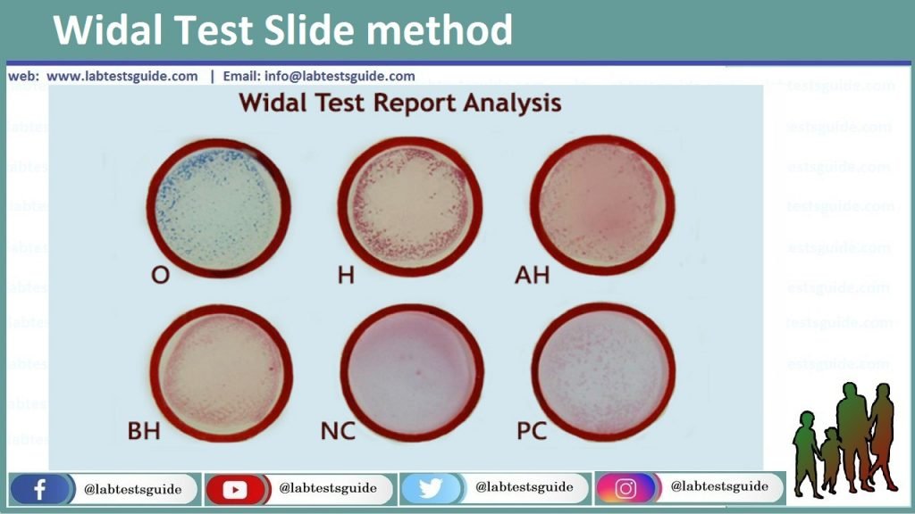 Widal Test Procedure Purpose, Procedure, Reasult and More - Lab Tests Guide