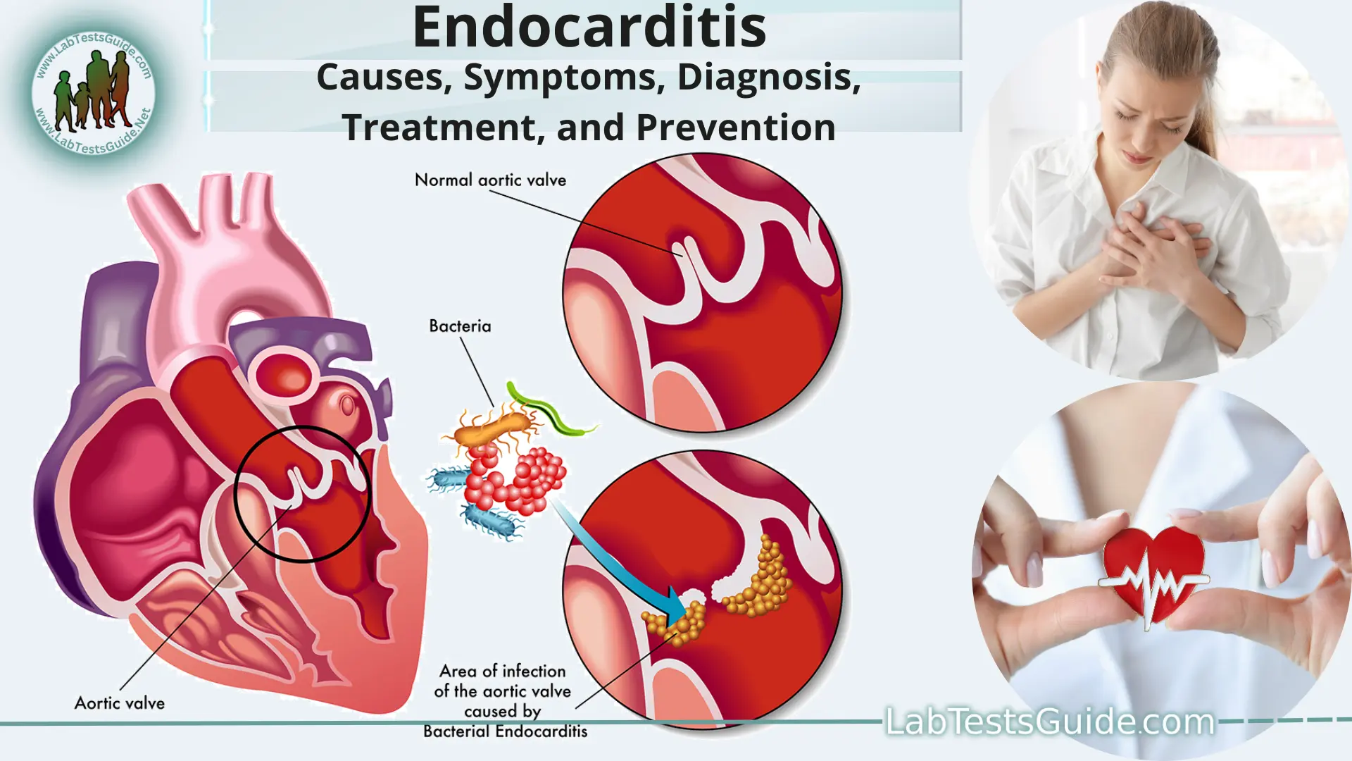 Endocarditis Causes Symptoms Diagnosis Treatment And Prevention