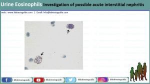 Urine Eosinophils Investigation of possible acute interstitial ...