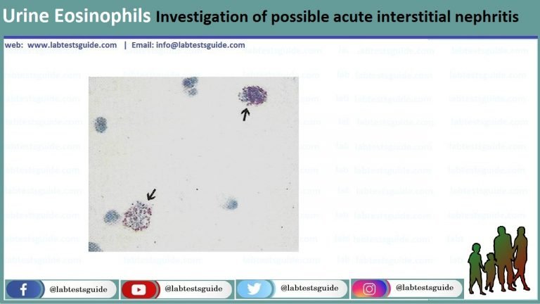 Urine Eosinophils Investigation Of Possible Acute Interstitial ...