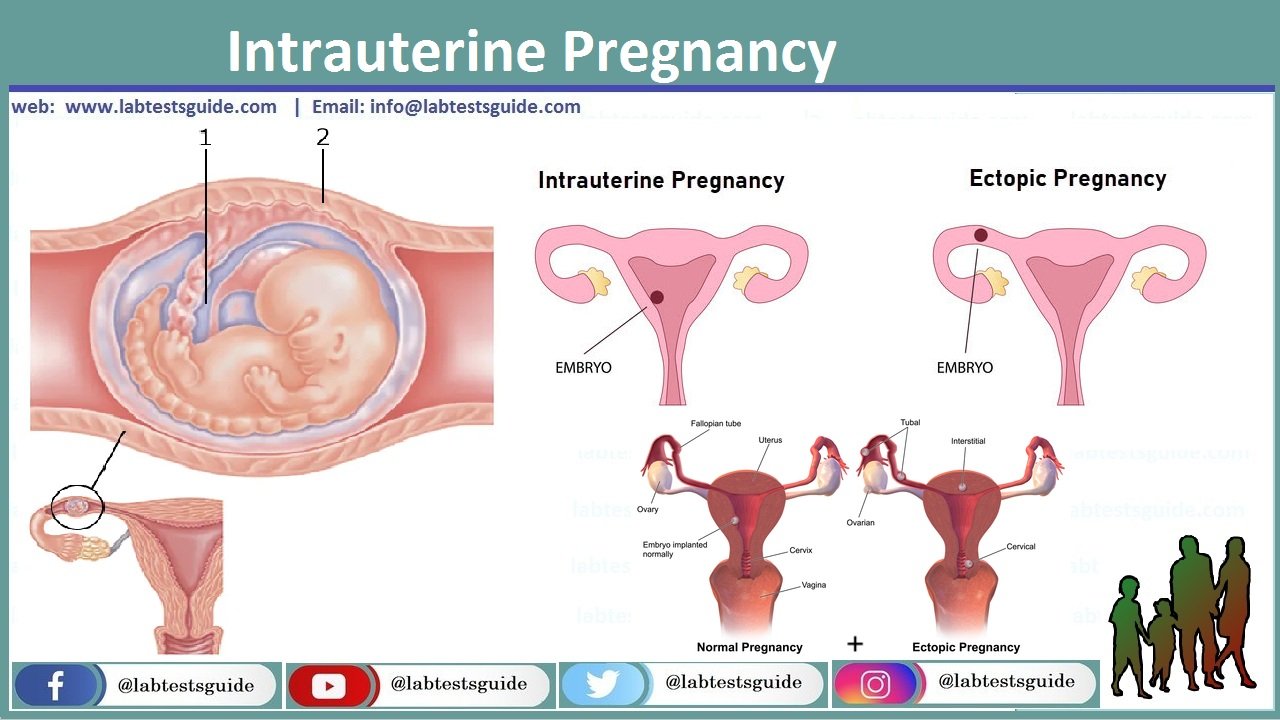 Intrauterine Pregnancy Understanding Development Signs And Care