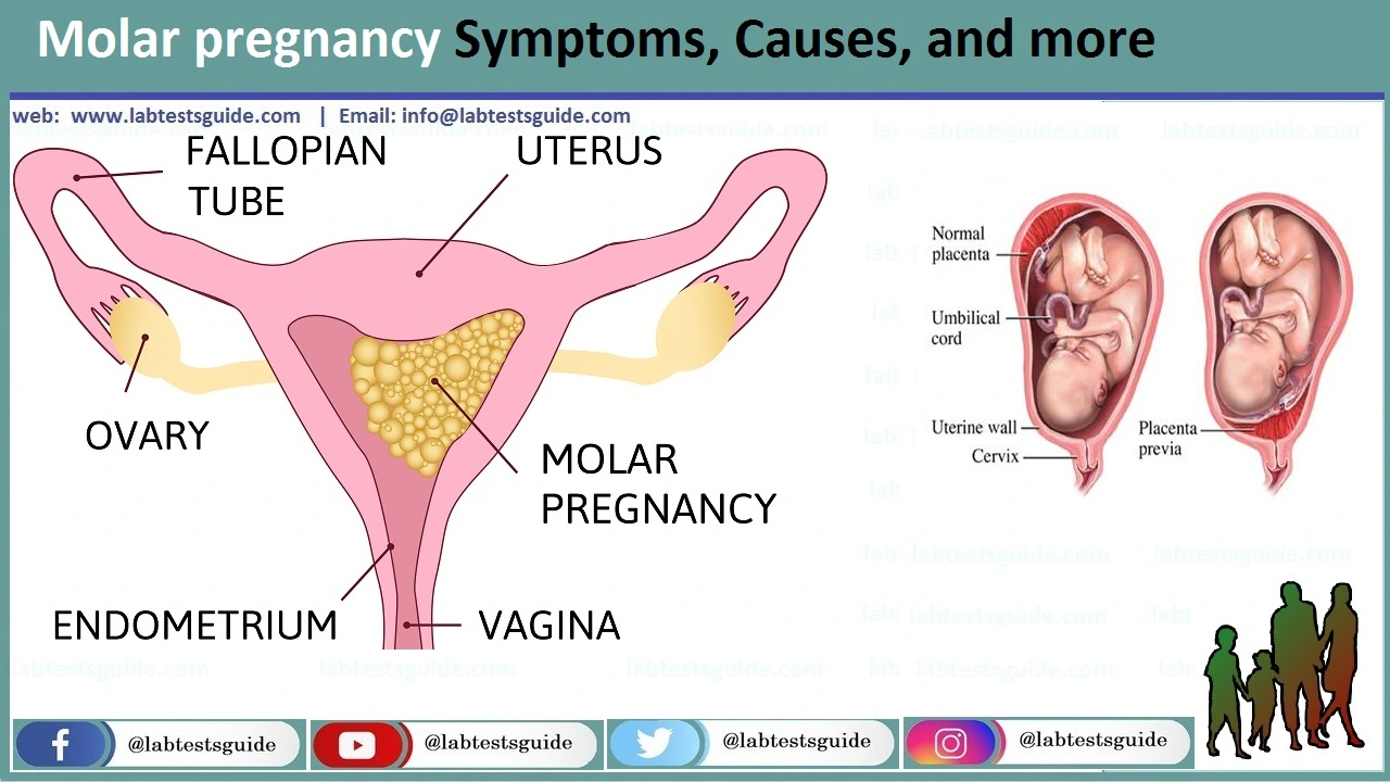 Molar pregnancy - Symptoms and causes - Mayo Clinic