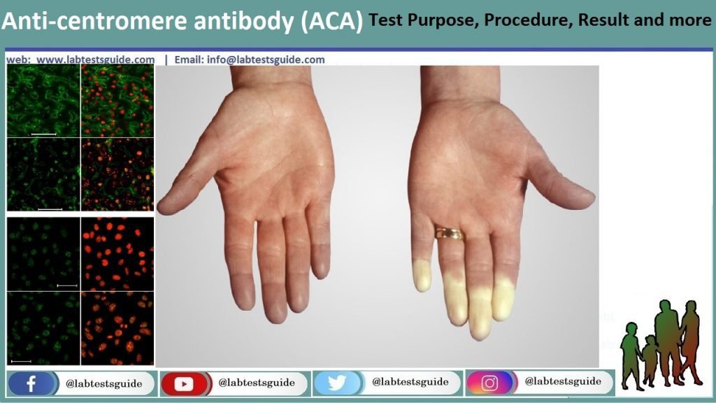 Smith Antibody Test Result, Purpose, Procedure and more Lab Tests Guide