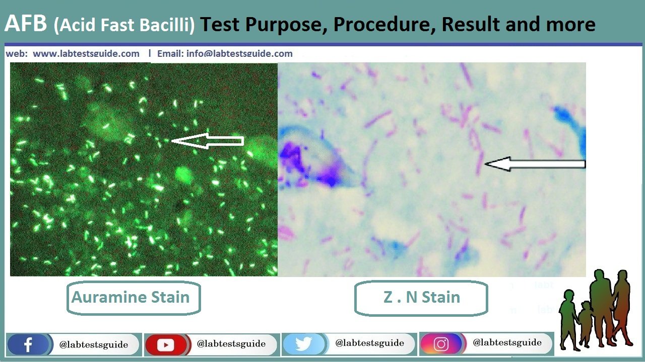 CSF For AFB Test Purpose, Procedure, Result and more | Lab Tests Guide