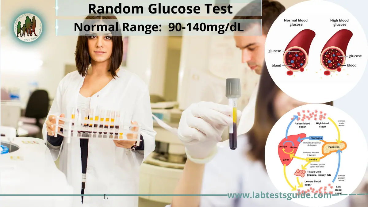 Random Glucose Test Purpose, Procedure, Result Interpretation and more