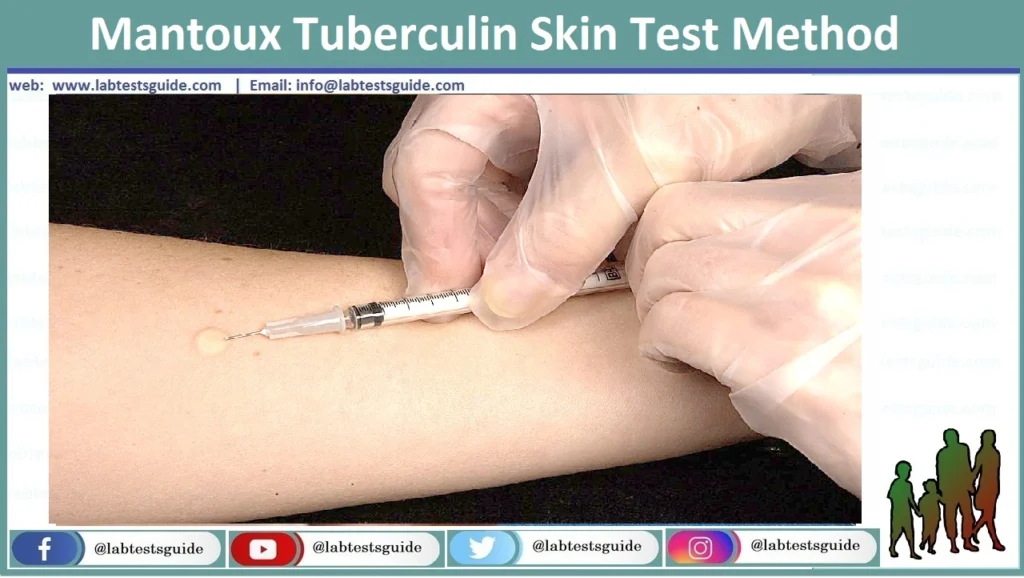 Latent Tuberculosis Infection Test