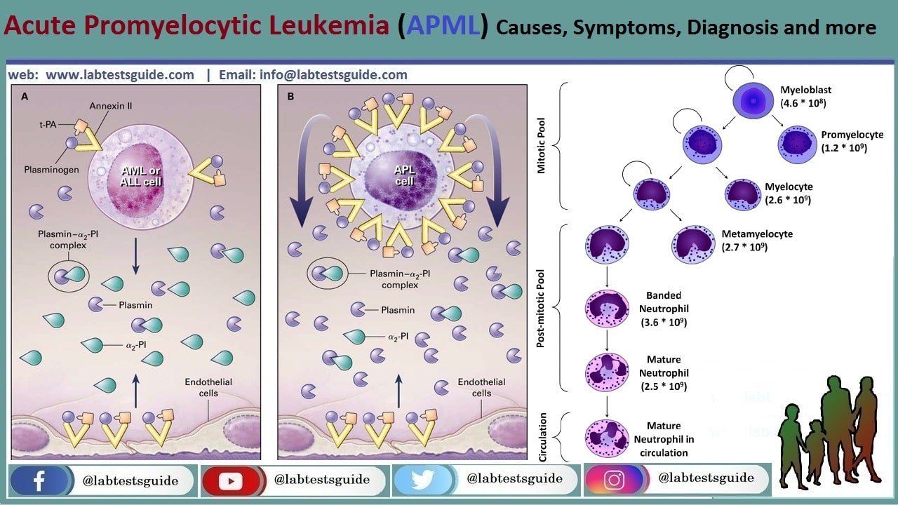 Acute Promyelocytic Leukemia Apml Lab Tests Guide