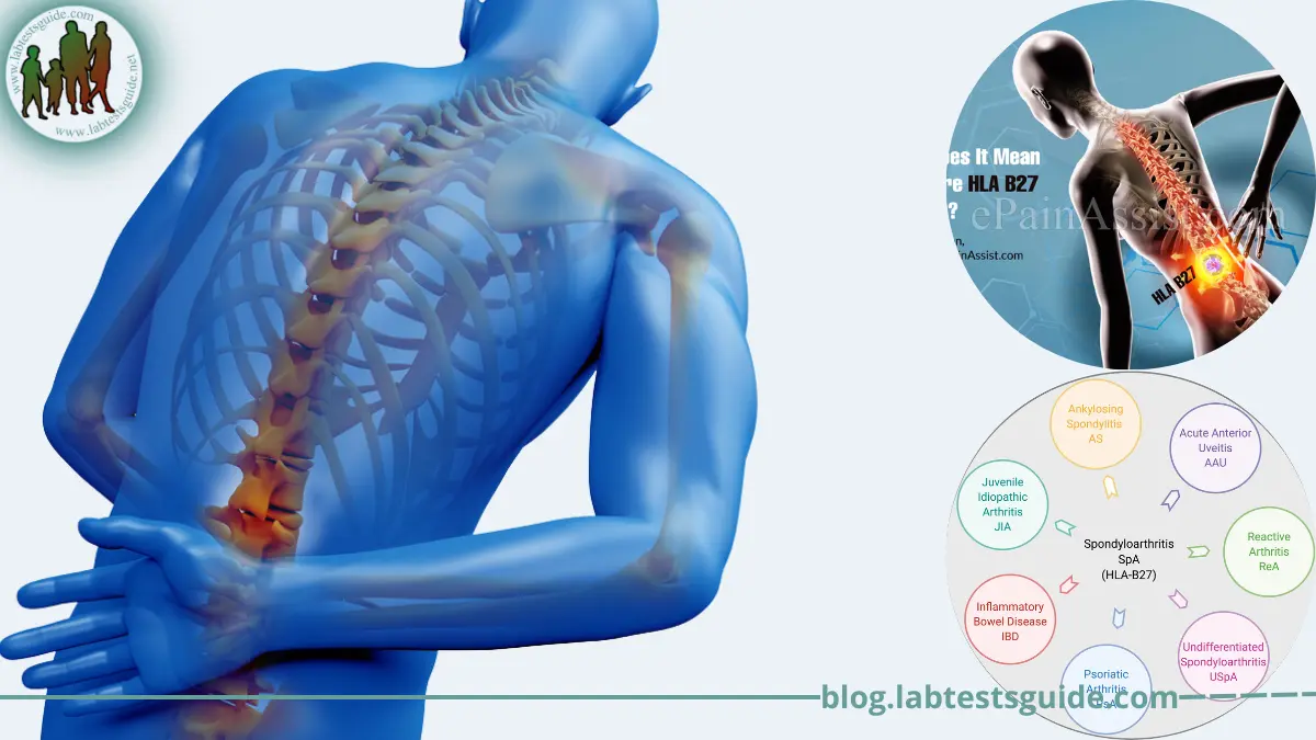 Ankylosing Spondylitis-HLA Test Purpose, Procedure, Result And More