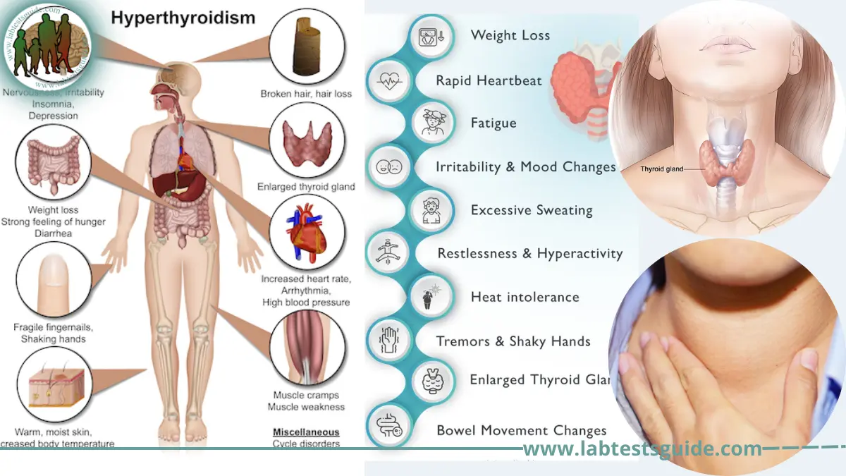 Overactive Thyroid Hyperthyroidism Symptoms Causes Diagnosis And More