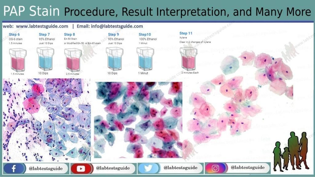 Papanicolaou Staining Pap Stain Principle Procedure Results Hot Sex Picture 1512