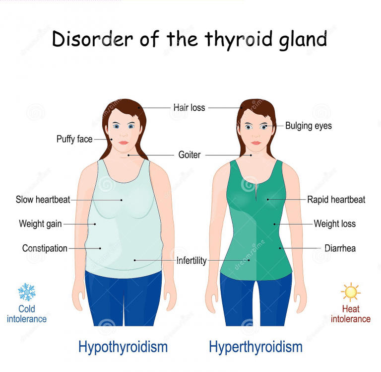 hyperthyroidism-symptoms-causes-diagnosis-and-more-ltg