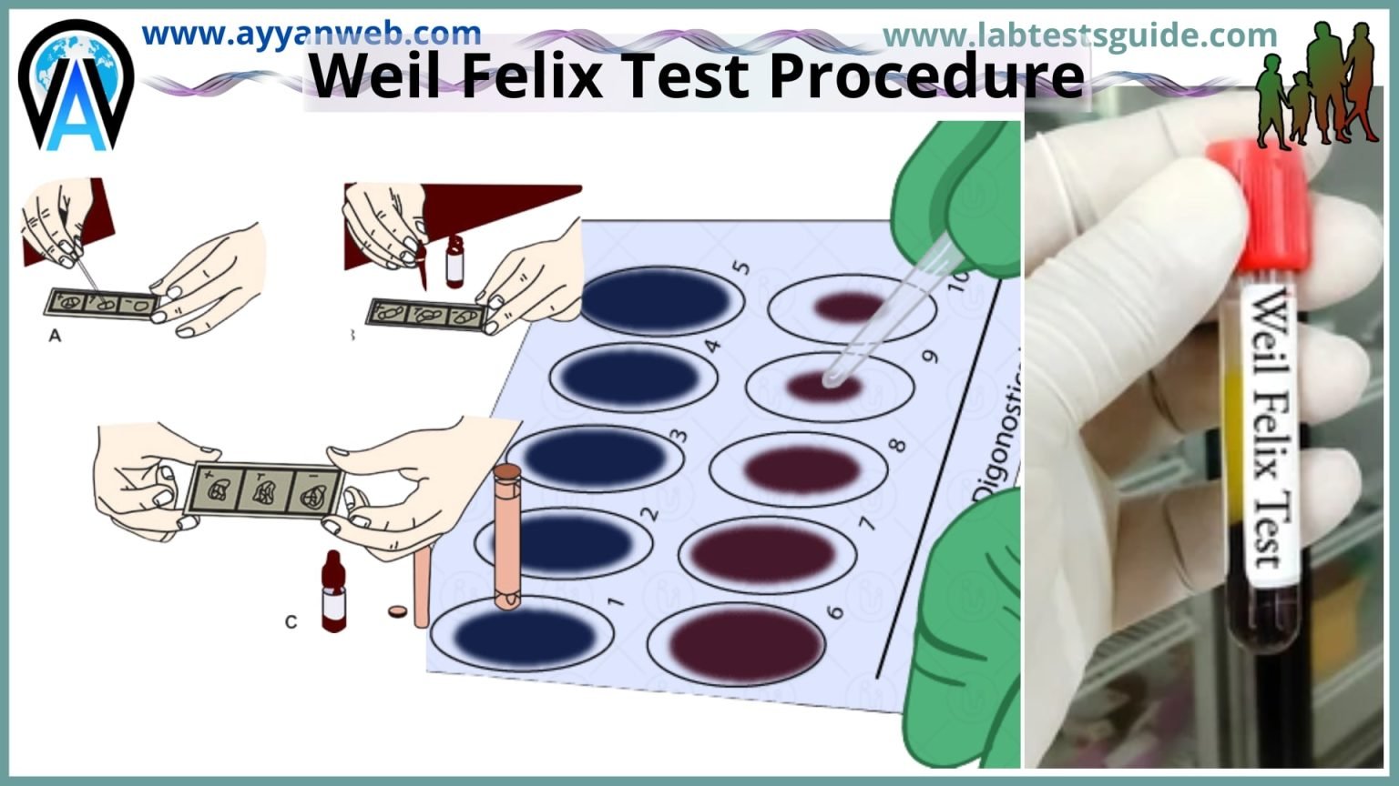 Urea Test Procedure Principle Results And More Lab Tests Guide