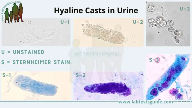 Hyaline Casts