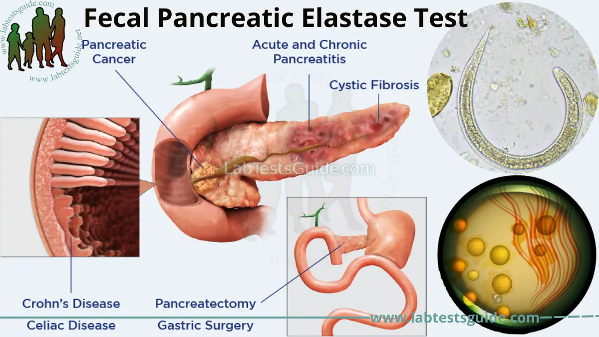 Fecal Pancreatic Elastase Test Purpose Procedure And Results 