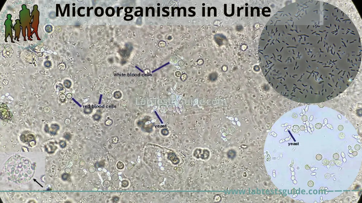 rare yeast in urine