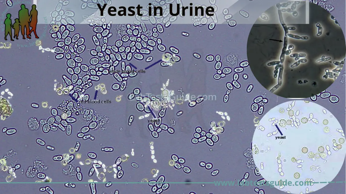 rare yeast in urine