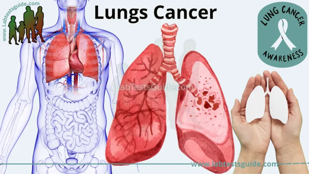 Lungs Cancer Symptoms, Causes, Diagnoses | Lab Tests Guide